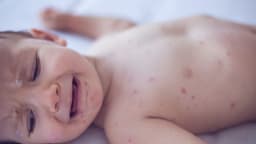 Measles killed 6-week-old baby, coroner confirms after RFK Jr. disputed deaths