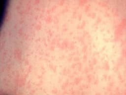 Measles will be in Onondaga County soon, health official says: ‘It’s coming for us’