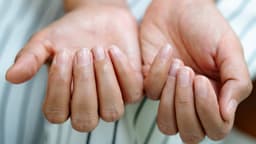 GLP-1 Users Are Reporting Their Fingernails Detaching