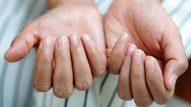 GLP-1 Users Are Reporting Their Fingernails Detaching