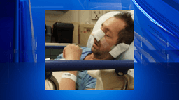 Former motocross rider shares how opioid addiction led to fentanyl use, sepsis, and the loss of his nose