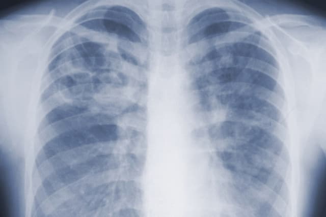 Years after he quit smoking, a lung cancer scan saved his life