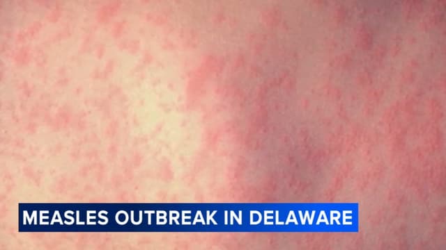 Measles outbreak declared in Delaware; cases also rising in Chester County, Pa.