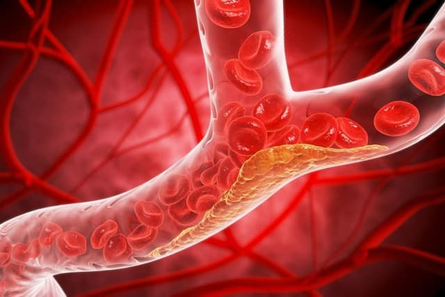 New Treatment Cuts “Bad” Cholesterol in Half for a Full Year