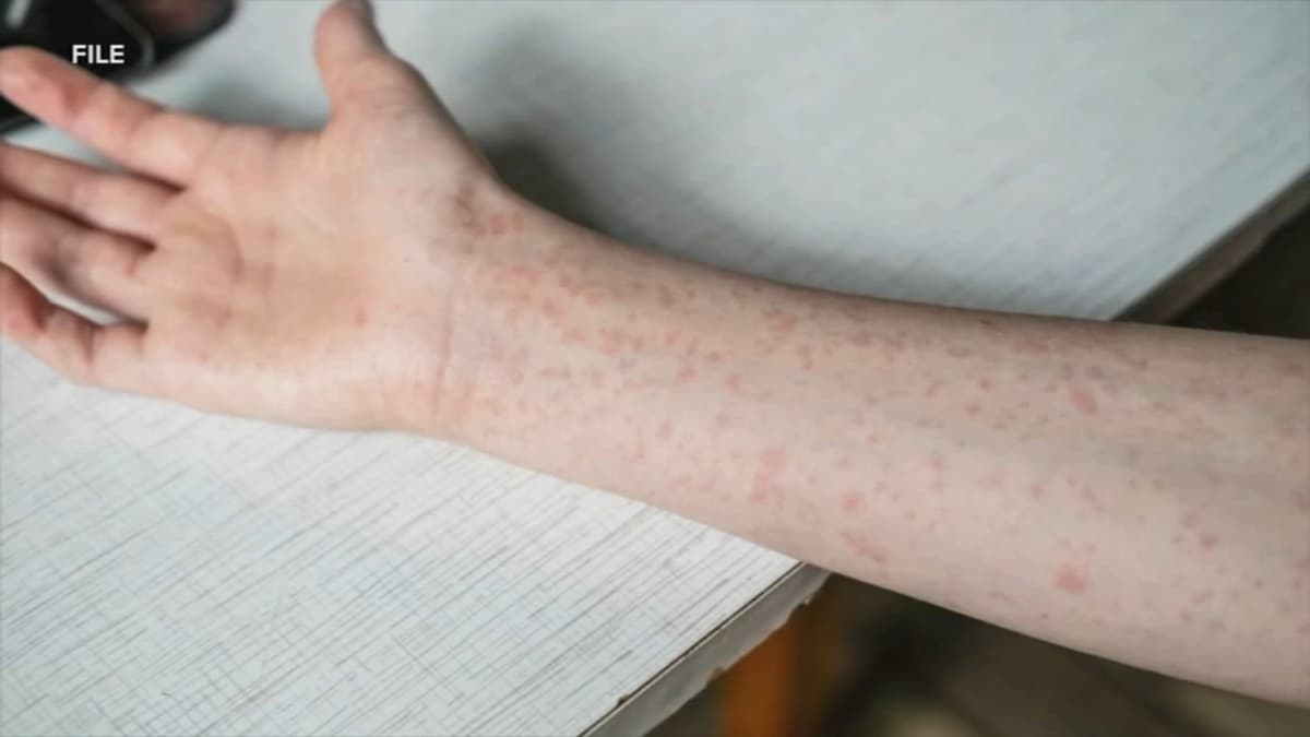 Oxford Area High School closed Friday after confirmed case of measles