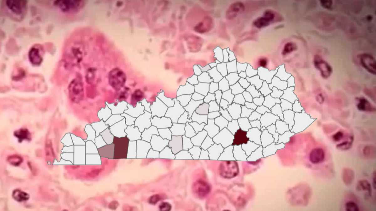 Measles cases surge past 150 in Kentucky; big outbreak identified in one county