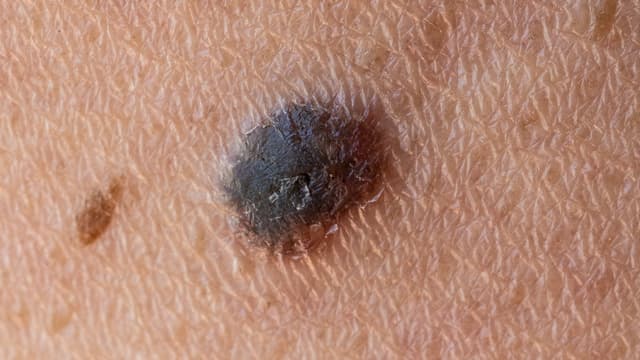 World-First Cancer Vaccine Cuts Melanoma Recurrence or Death Risk by 42% in Landmark Trial
